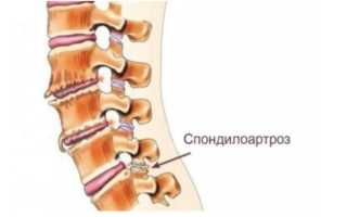 Спондилоартроз пояснично-крестцового отдела позвоночника — что это такое, как его диагностируют и лечат