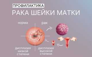 Стоит ли бояться рака при ВПЧ?