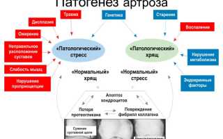 Остеоартроз — причины, симптомы, классификация и этапы развития