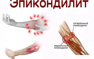 Эпикондилит локтевого сустава — лечение традиционными и народными методами