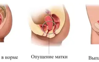 Операции при выпадении матки: причины, методы и восстановление