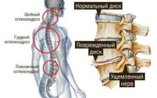Как проводят лечение остеохондроза позвоночника