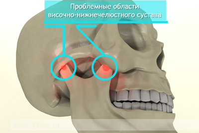 Воспаление челюстного сустава