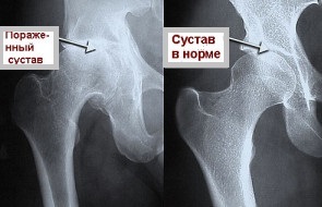 Рентген тазобедренного сустава при артрите
