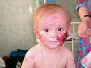 экзема на теле у ребенка лечение