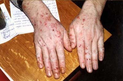 экзема фото