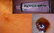 лечение от черных точек в домашних условиях