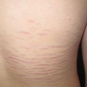 От чего появляются растяжки на спине