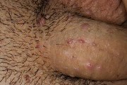 папилломавирус самые опасные типы впч