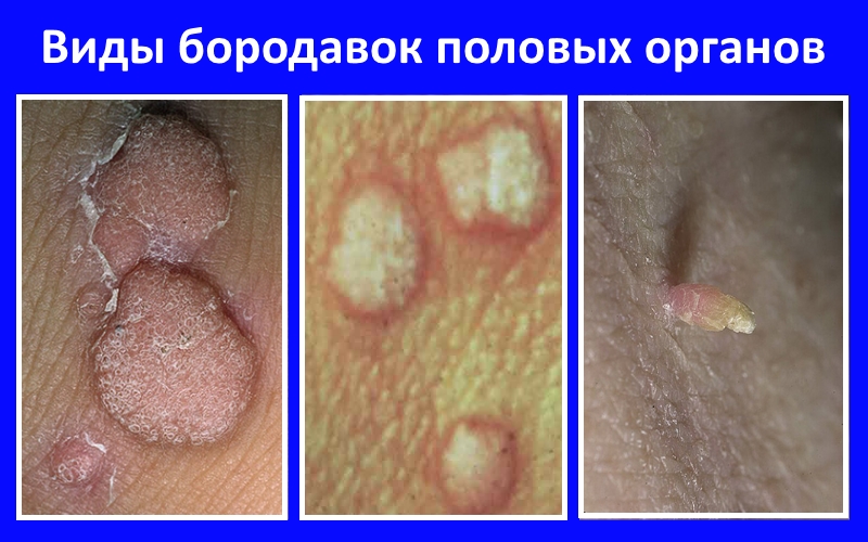 половые папилломы