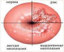 впч 18 типа