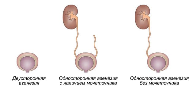 Агенезия почки - схема