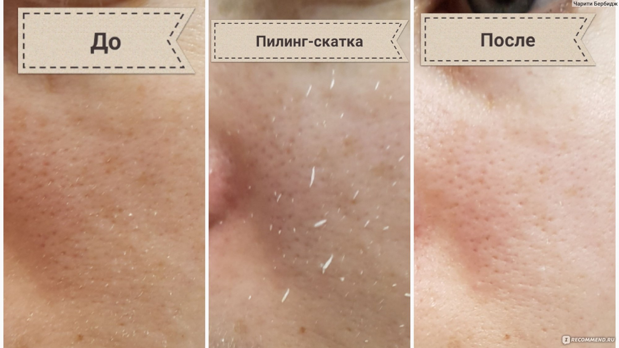 пилинг скатка до и после
