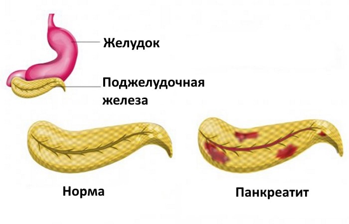 Схематичное изображение панкреатита