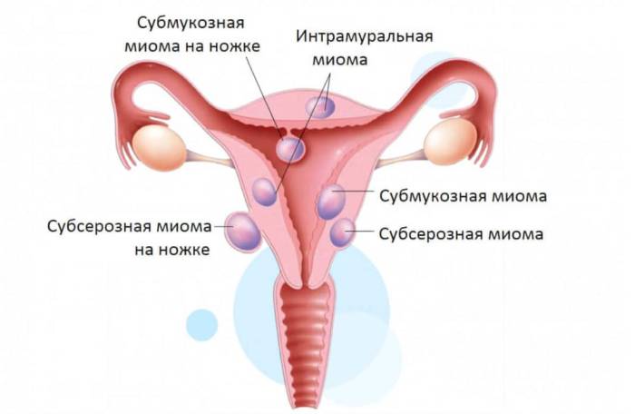 Чем опасна миома