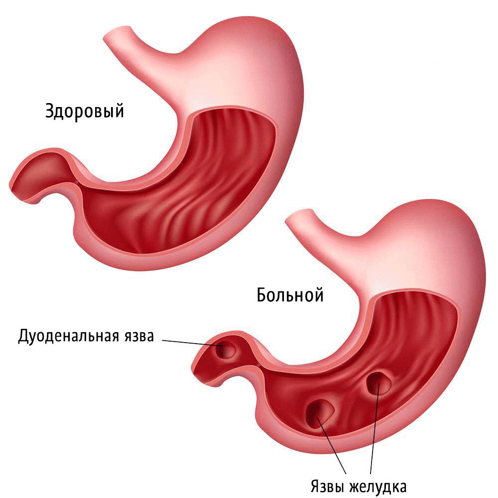 Язва 12 перстной кишки (дуоденальная)