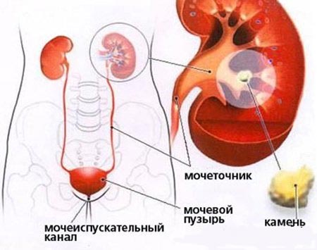 камни в почках