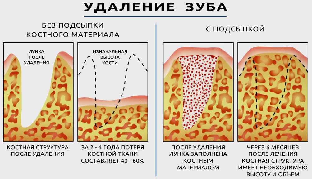 Как происходит наращивание костной ткани перед имплантацией зубов - описание этапов