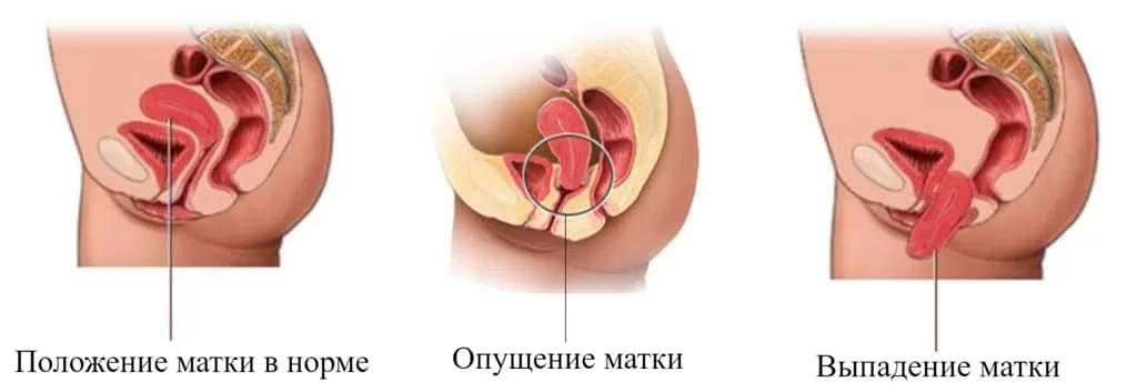 Операция при опущении и выпадении матки (стенок влагалища) в клинике  хирургии GMS Hospital