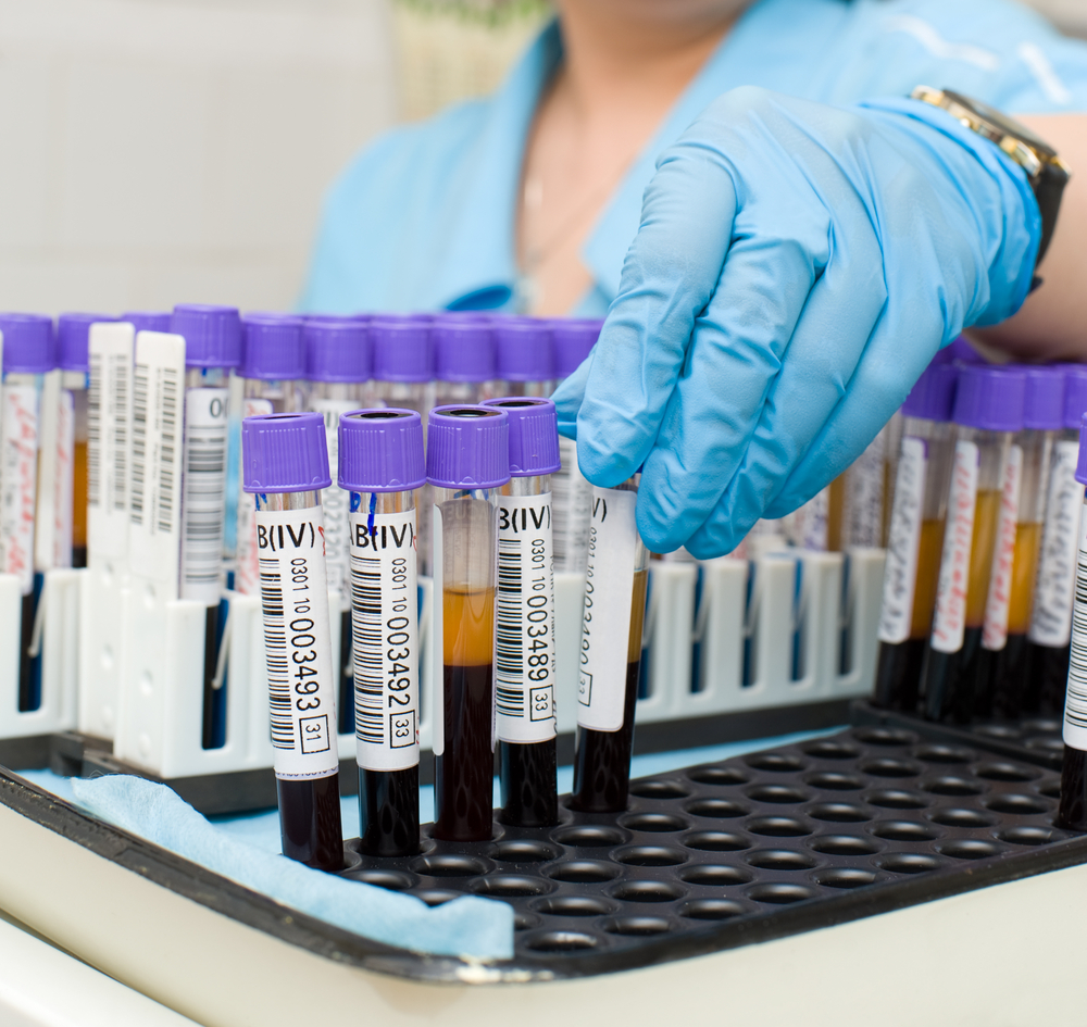 Анализ крови - метод диагностики приступа стенокардии Приступ стенокардии