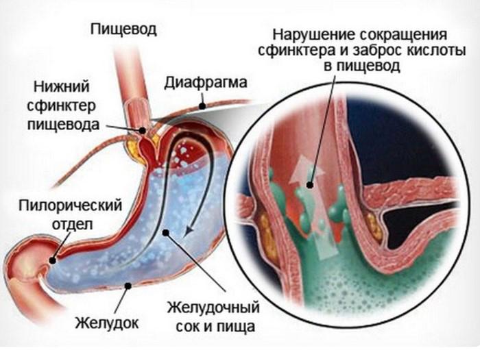 Рефлюкс-эзофагит