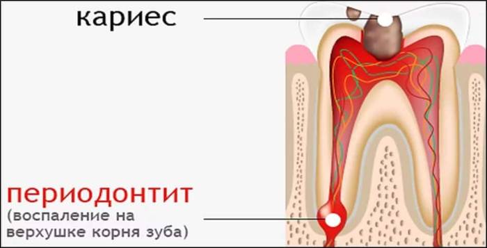 Периодонтит