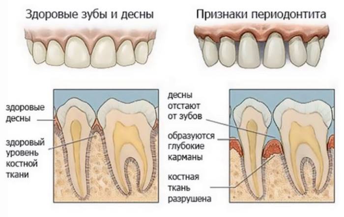 Признаки периодонтита