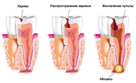 Воспаление десны и образование абсцесса
