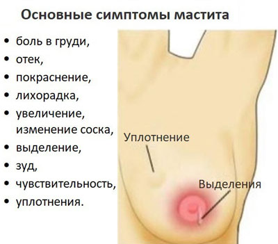 Зуд груди, как симптом мастита
