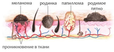Что представляют собой образования на коже