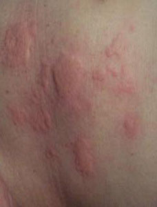 При каких заболеваниях появляются высыпания и чешется живот