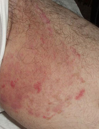 Воспаленные высыпания в области внутренней стороны бедра