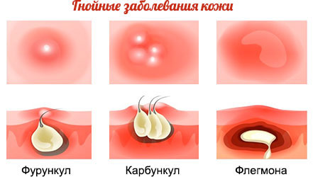 Какие бывают гнойные заболевания кожи