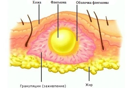 Гнойное воспаление жировой клетчатки