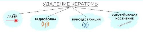Методы удаления кератомы