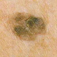 Почему родинка покрылась корочкой и что это значит?