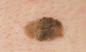 Почему родинка засыхает Если родинка покрылась корочкой или увеличилась, что это значит?