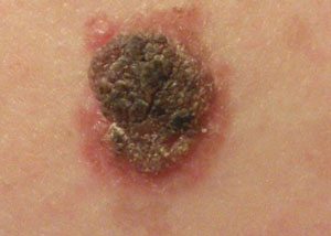 Родинка покрылась корочко и изменила цвет Причины появления корочки на родинке и насколько это опасно