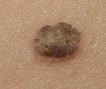 Корочка на родинке Что делать, если родинка покрылась корочкой