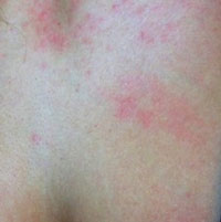 Красное пятно появилось на грудине у женщины