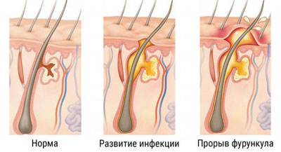 Как выглядит фурункул на коже