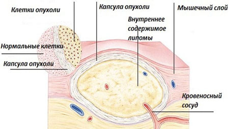 Как выглядит липома под кожей
