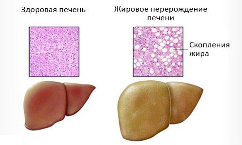 Жировое перерождение печени