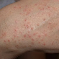 Сыпь в виде мелких точек красного цвета на руках
