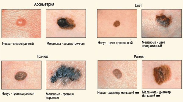Причины появления родинок на теле и методы лечения опасных меланом