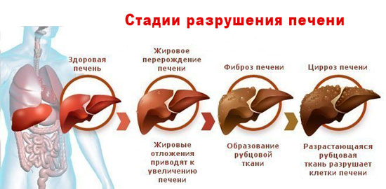 Как разрушается печень при циррозе