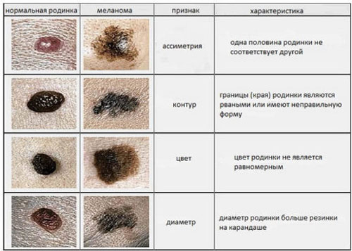 Признаки перерождения родинки в меланому