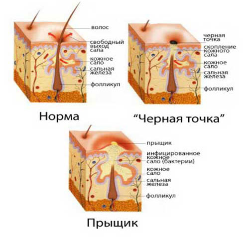 Отчего появляется внутренний прыщ