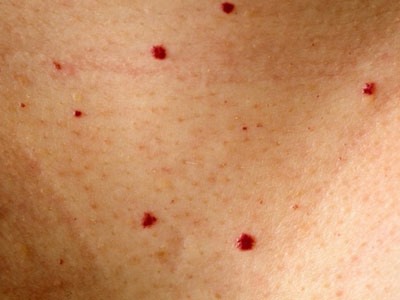 Рубиновые пятна на коже Высыпания на коже при болезни поджелудочной железы - рубиновые пятна