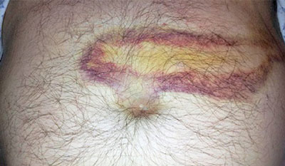 Кожные проявления при заболеваниях поджелудочной железы Пятна на коже при заболеваниях поджелудочной железы